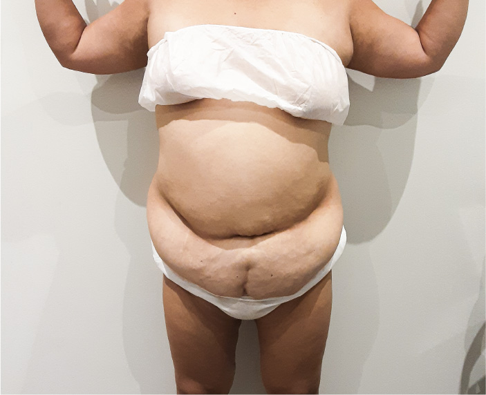 lipoescultura antes-monzani-80